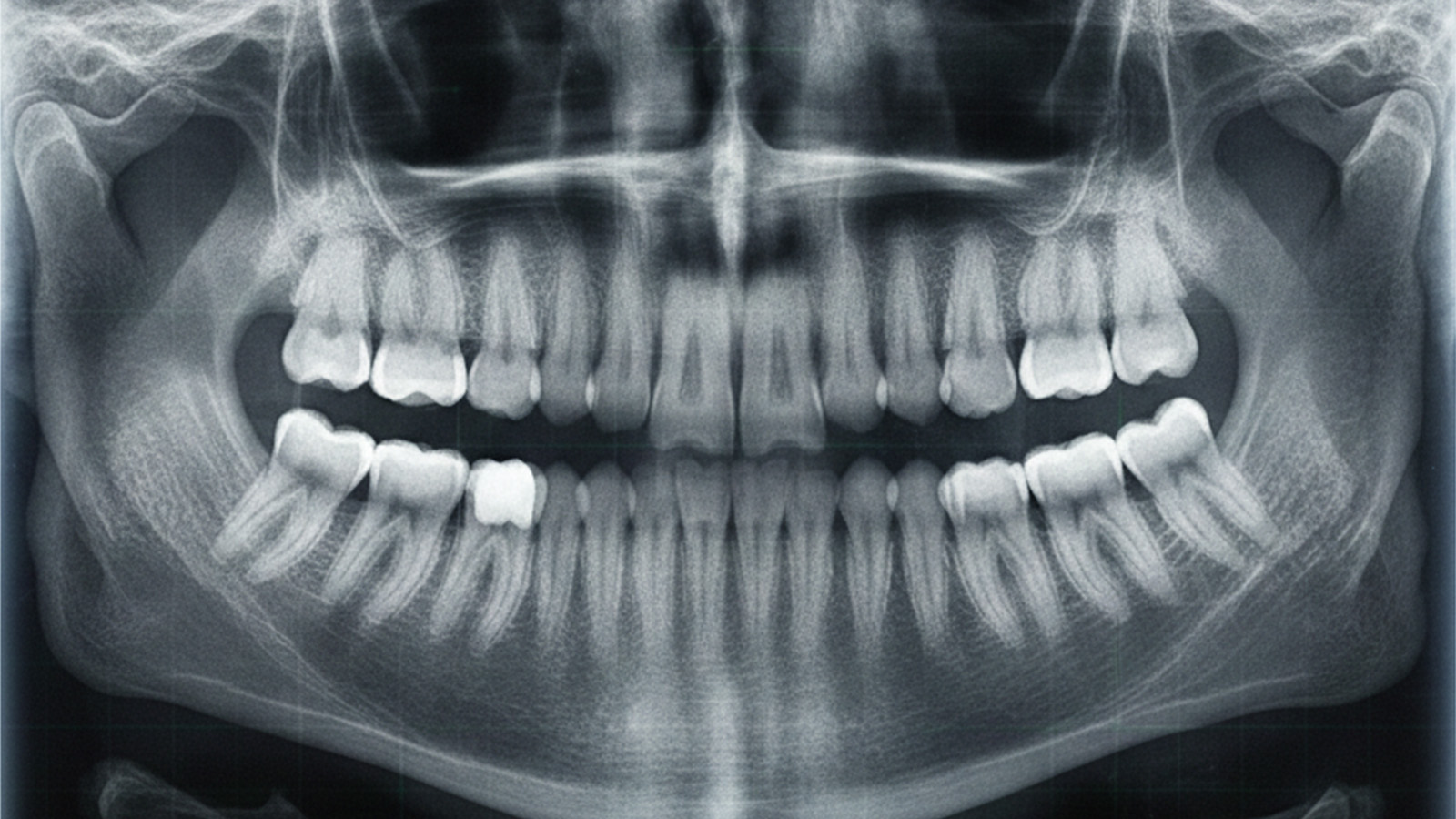 BoDent — RTG